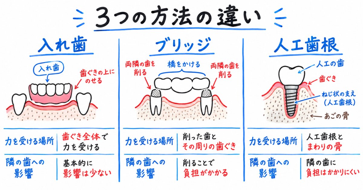 入れ歯・ブリッジとの違いから考える選び方
